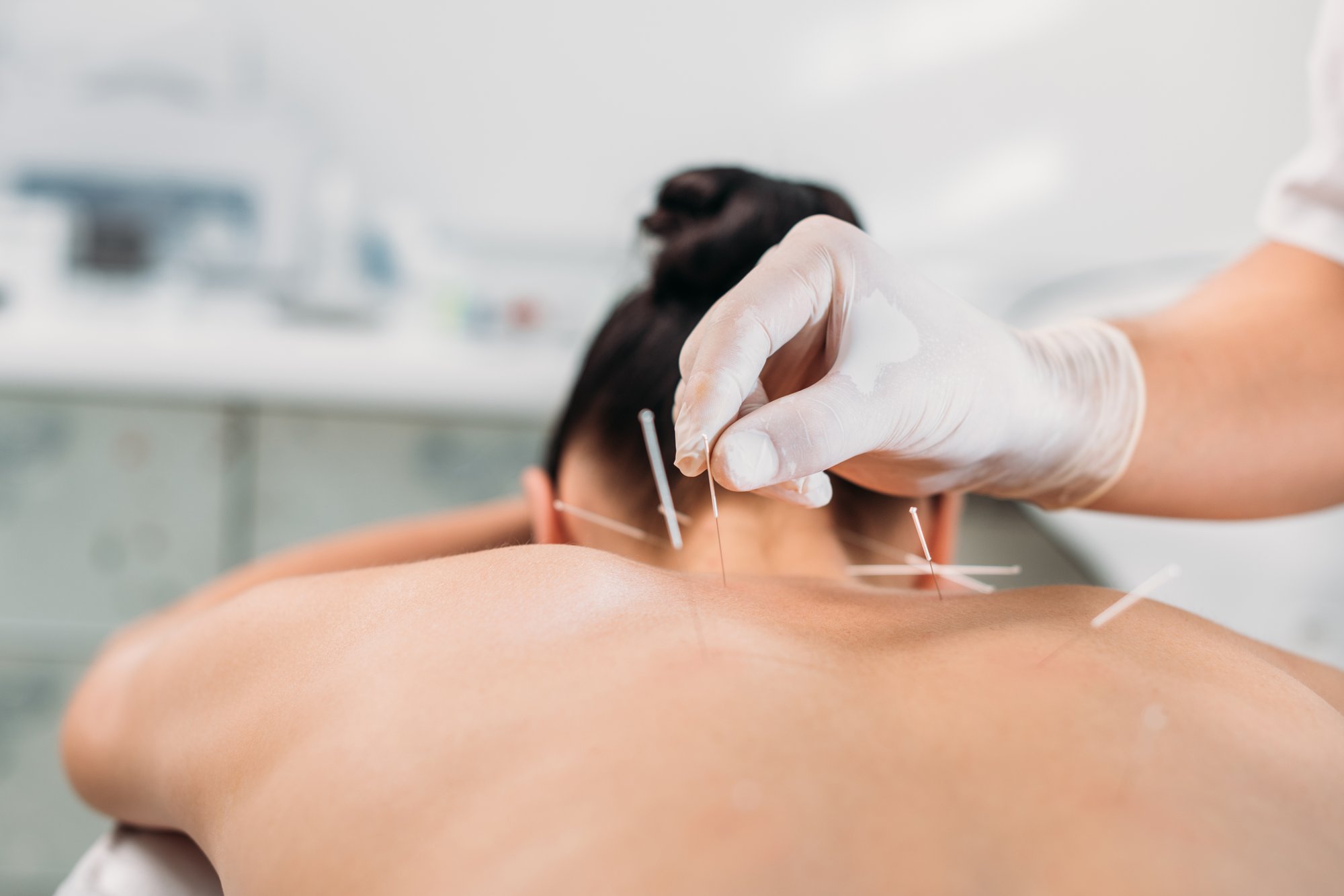 Dry needling upper back of patient