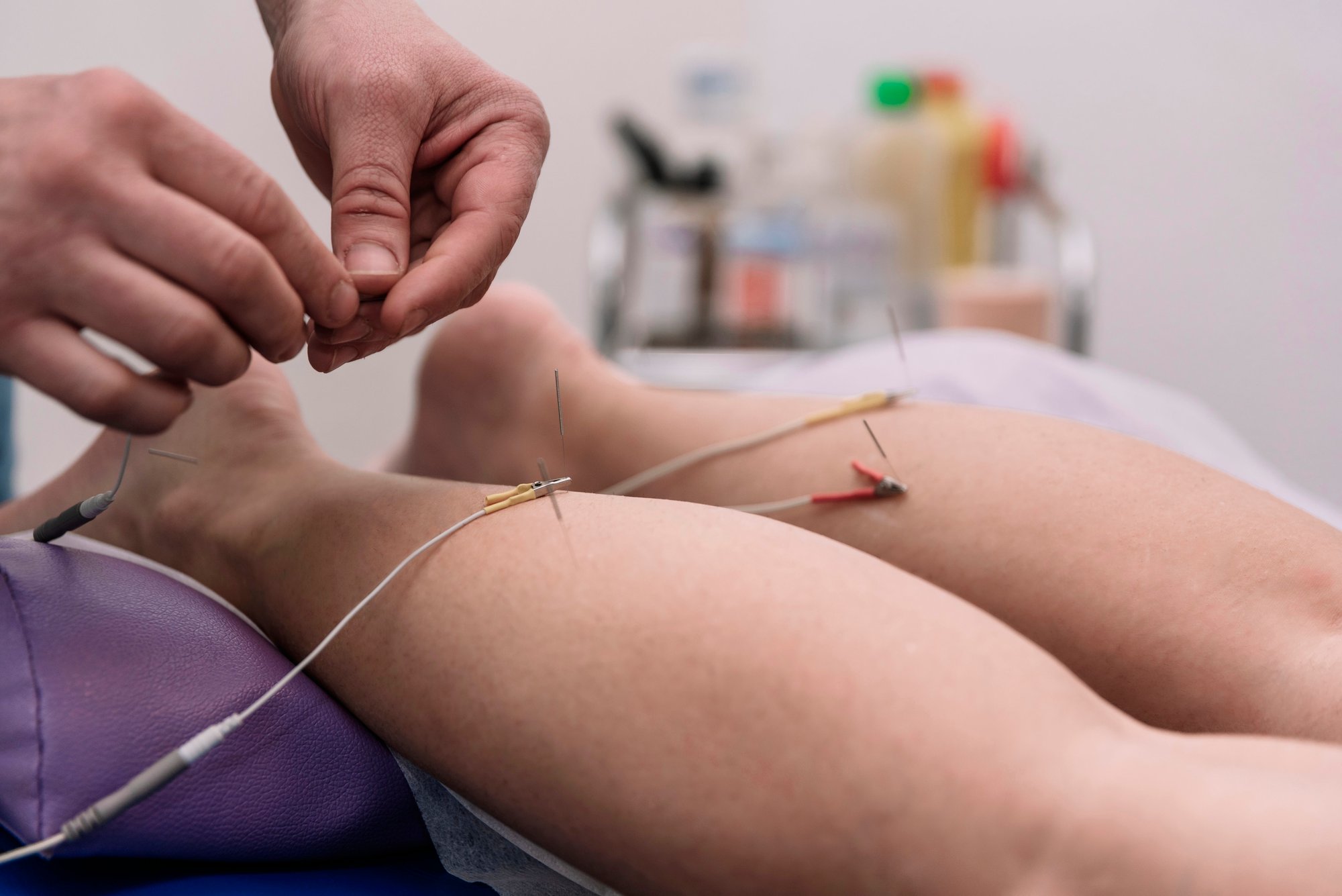 Electric Dry Needling on patient's calves