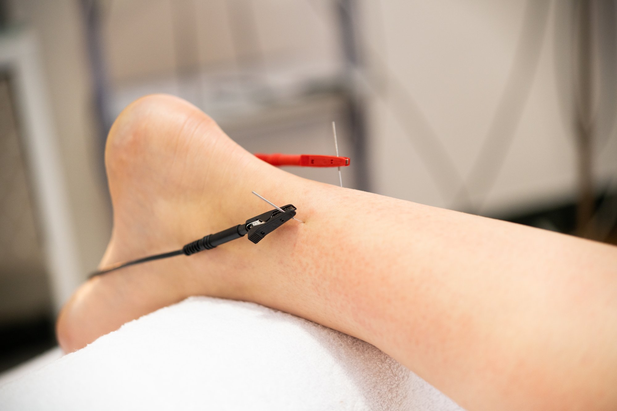 Electric dry needling patient's achilles