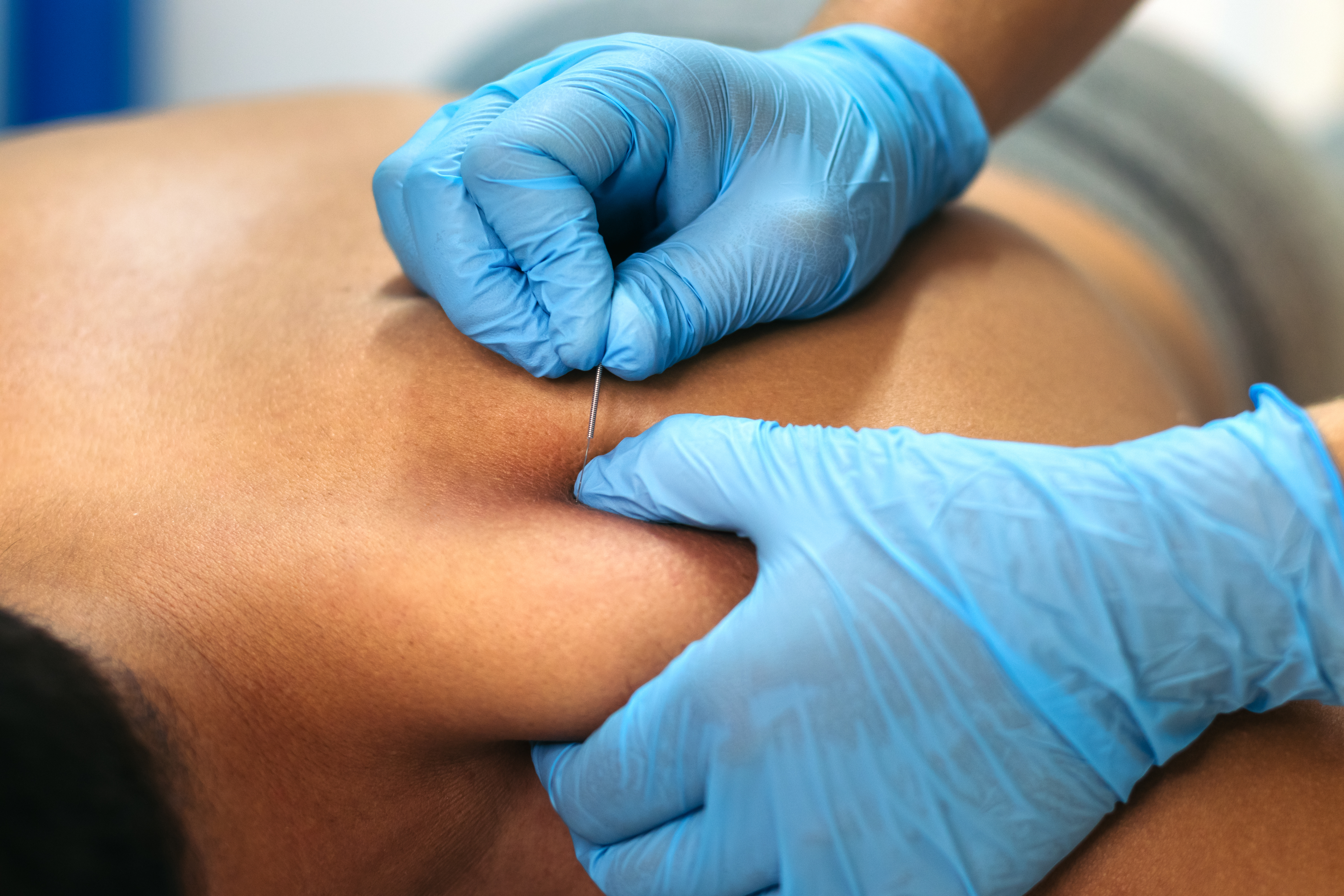 Dry needling with patient